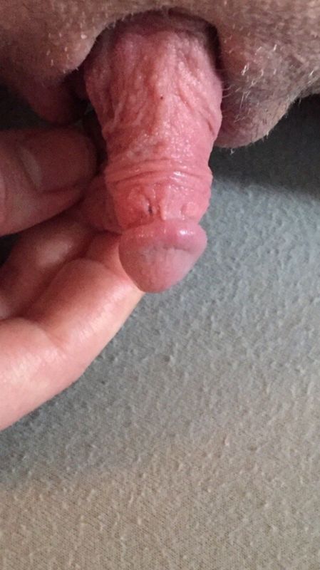 transsexual clitoris