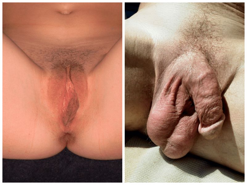 man with vagina and penis