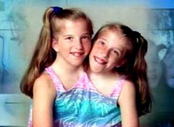 abby and brittany hensel who walks