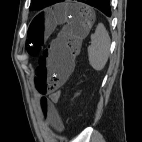 abdominal distress