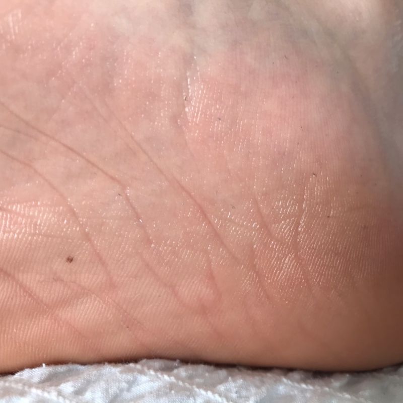 sore sweaty feet