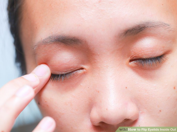 ptosis