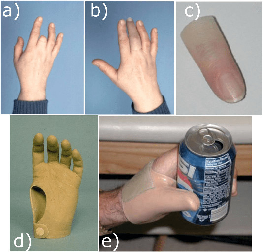 bilateral hand amputee