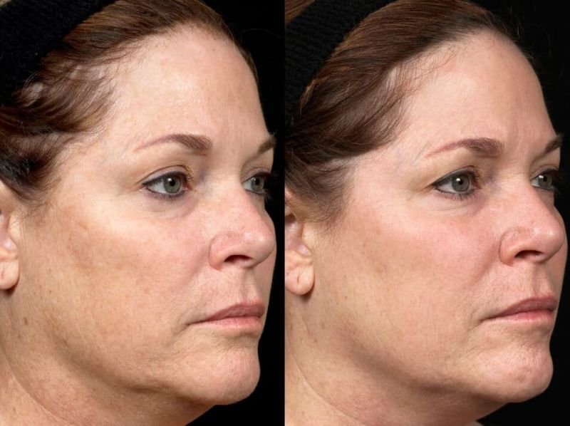 best laser for deep wrinkles