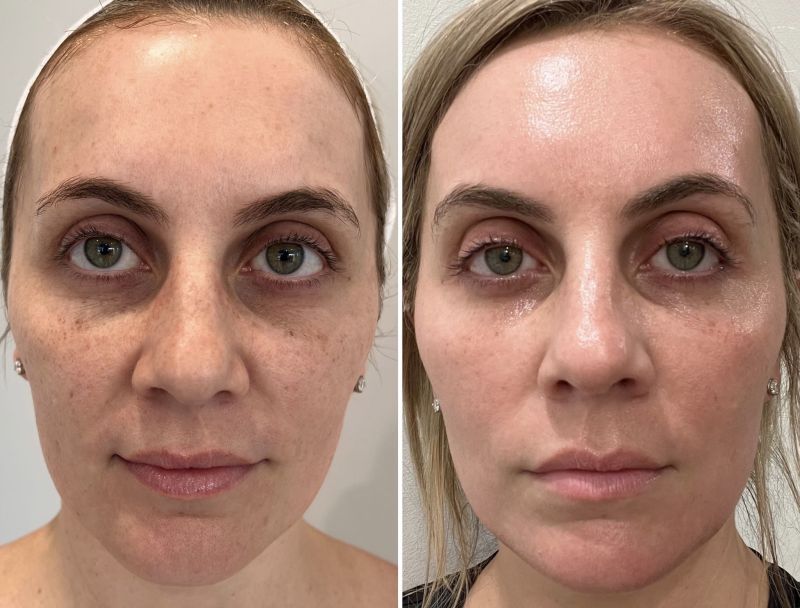 laser treatment before and after