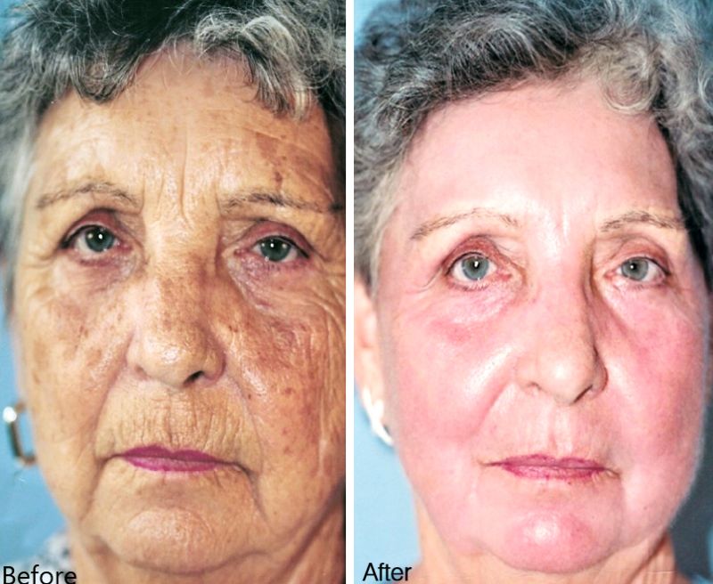 laser cataract surgery