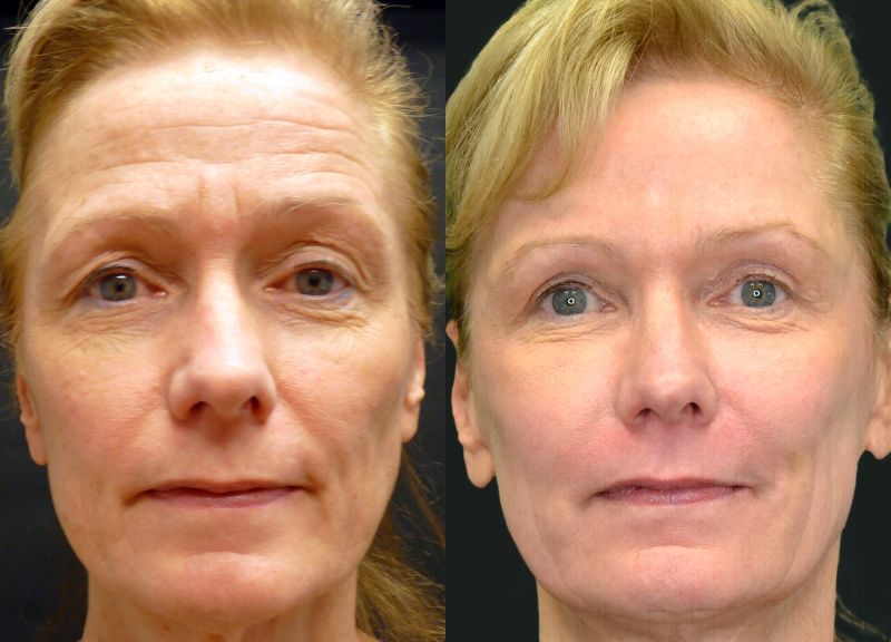 co2 laser surgery
