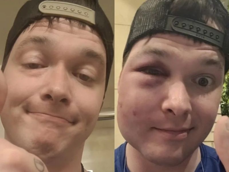 slap marks on face