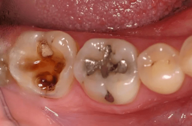 hole in tooth