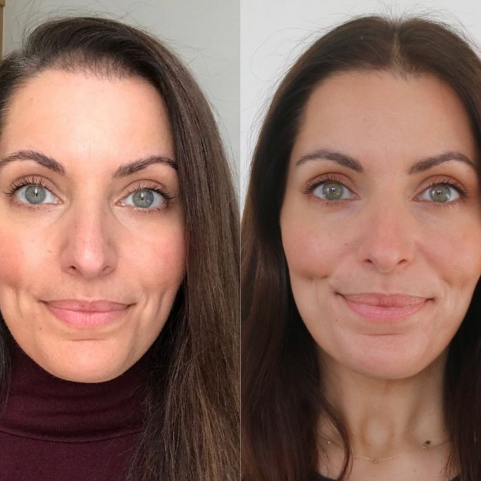 excessive hair growth hirsutism
