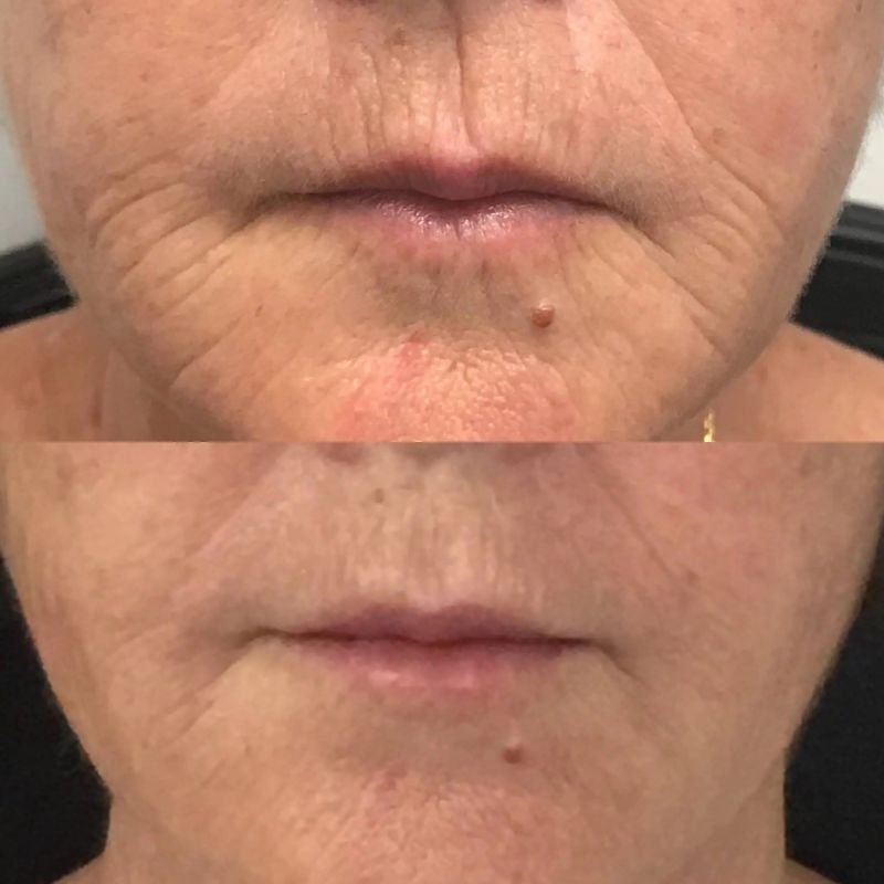 fillers for deep