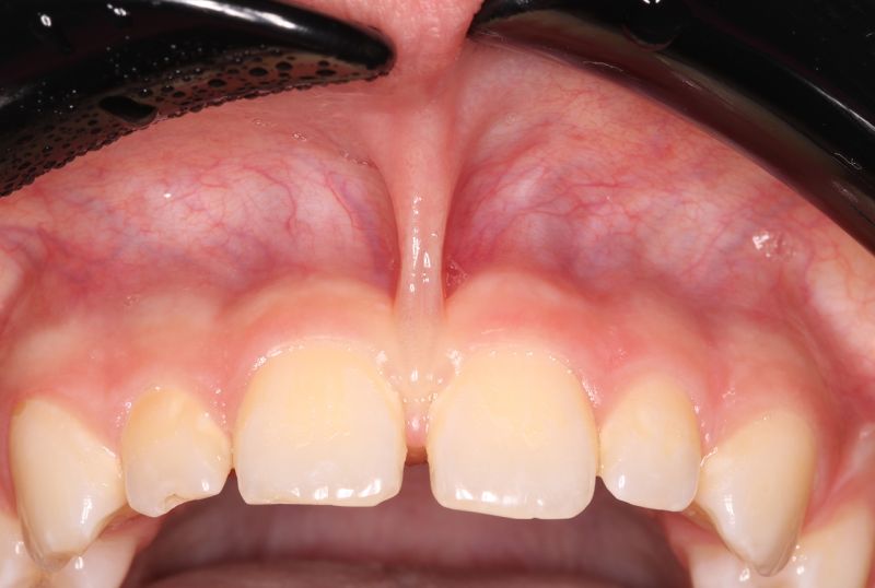 lower teeth gum recession