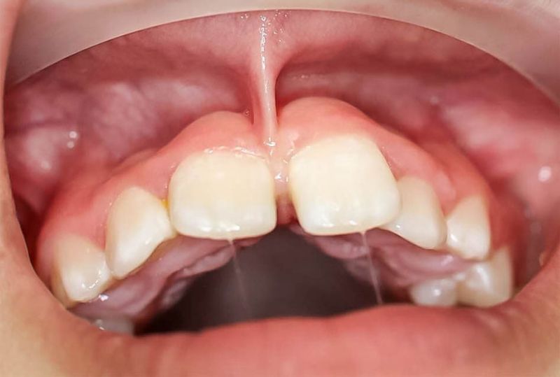frenulum connected to lip