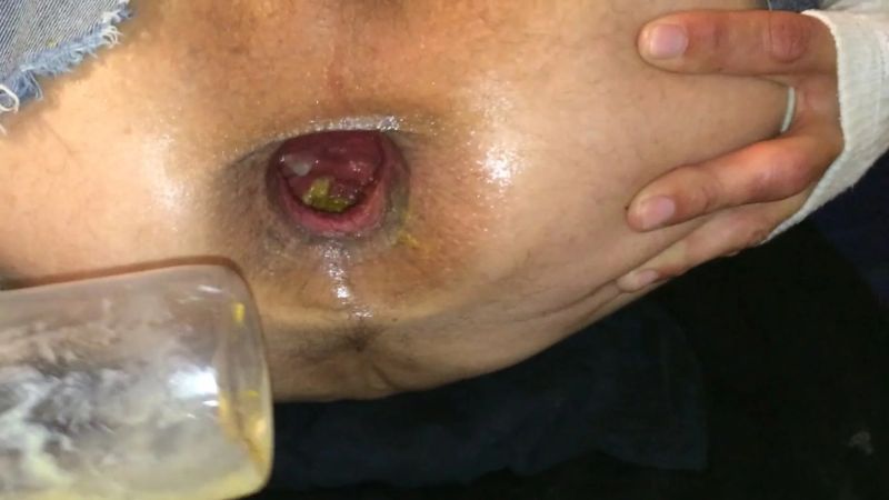 shemale anal gape