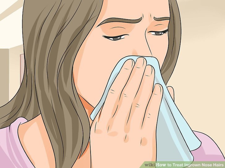 ingrown hair scars