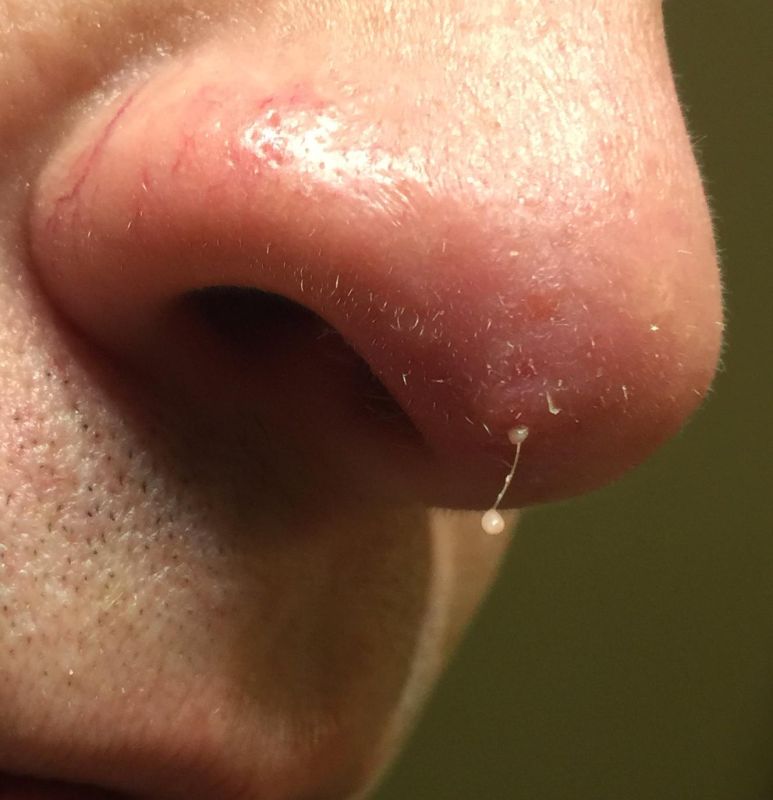 infected nose hair