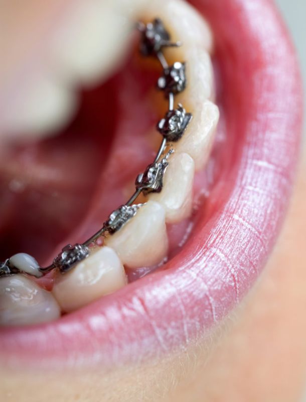 orthodontic tongue crib