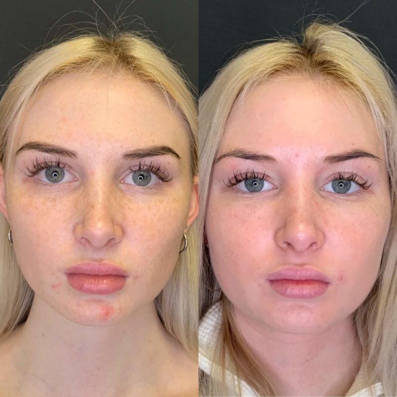 micro dermabrsion before and after