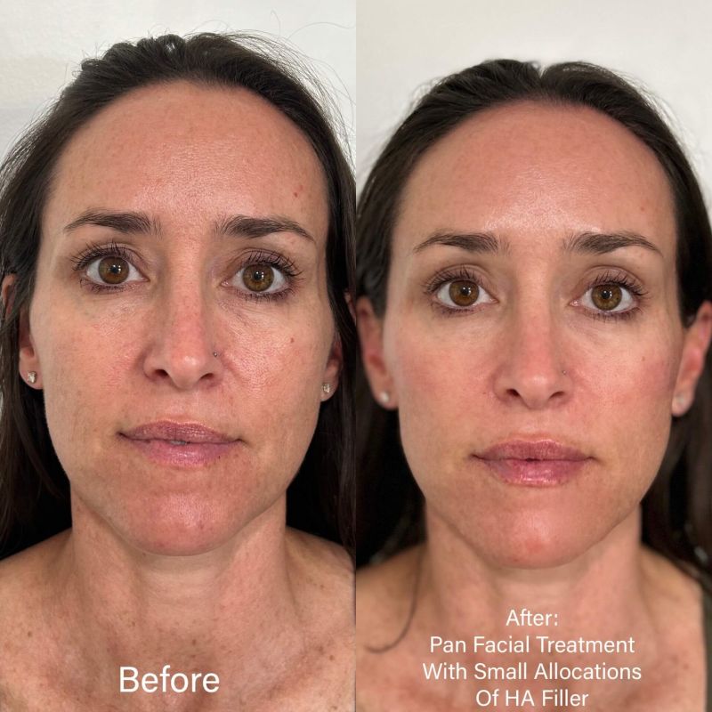 microdermabraion before and after photos