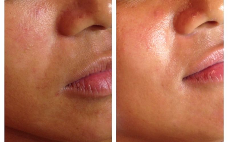 microdermabrasion under eyes