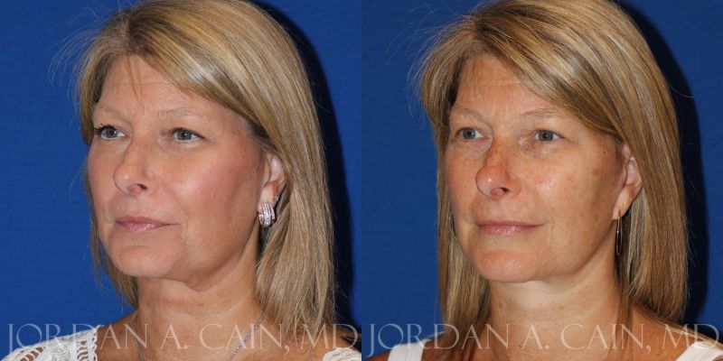 face fillers