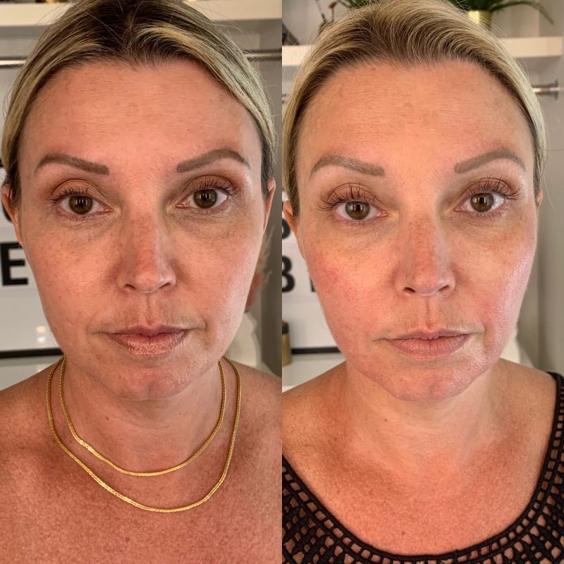 microdermabrasion facial 1 session before and after