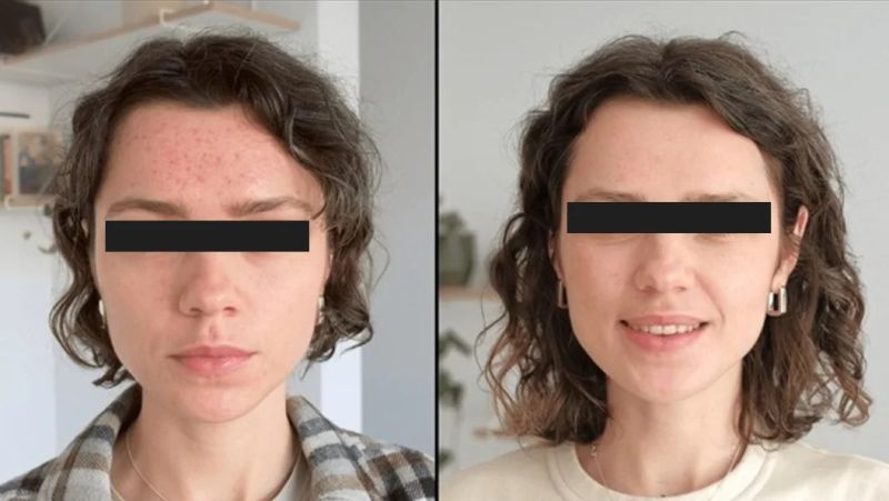 microdermabrasion process