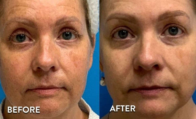 skinbase microdermabrasion