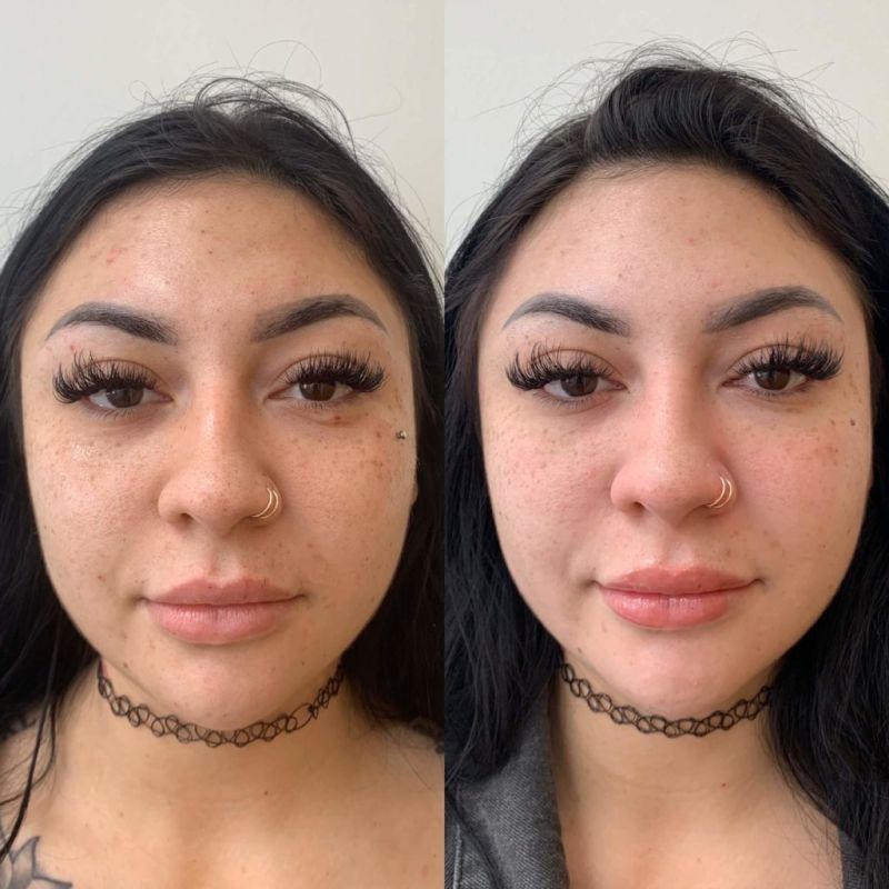 derma roller stretch marks before and after