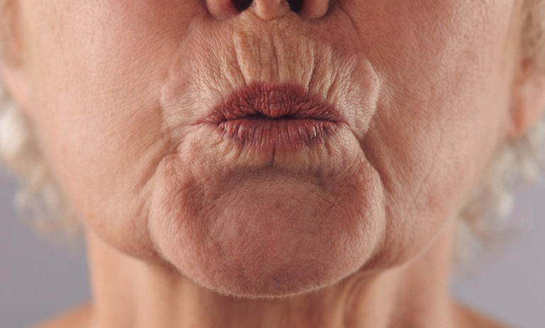 getting rid of wrinkles