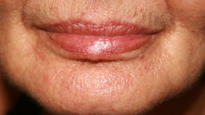 women with lip wrinkles