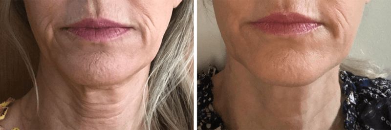 what causes wrinkles around mouth