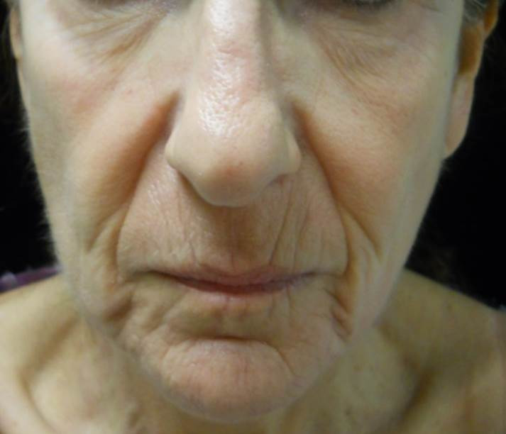 before after threading